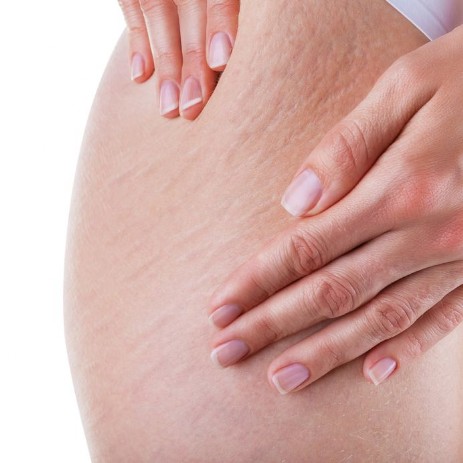traitement cellulite